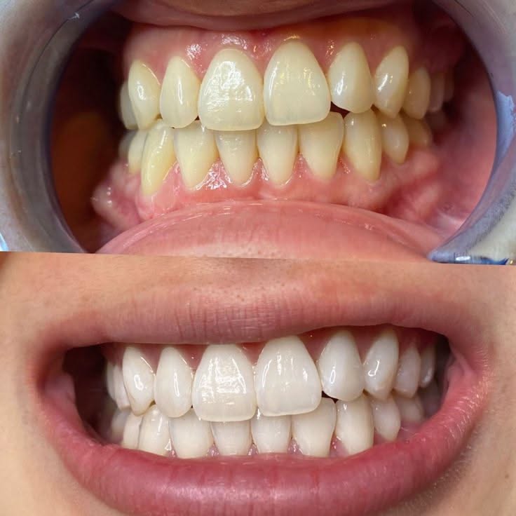 Teeth Whitening Powder